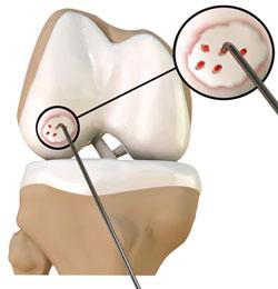 Osteochondritis