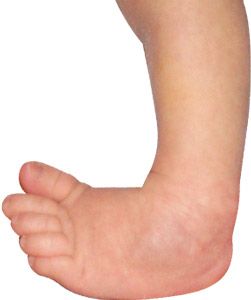 Clubfoot