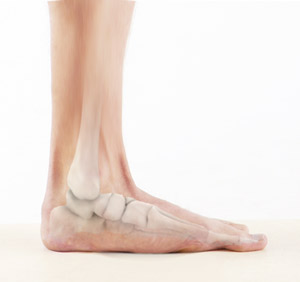 Flatfoot Correction