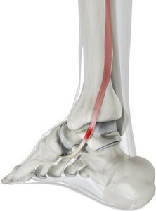 Posterior Tibial Tendon Dysfunction