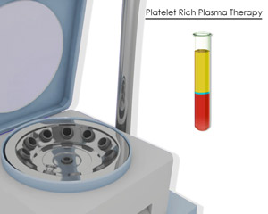 Platelet Rich Plasma Therapy