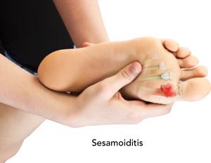 Sesamoiditis