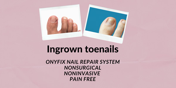 Ingrown toenails